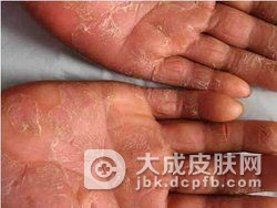 自体敏感性湿疹如何预防