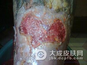 臁疮腿患者哪些食物不能吃