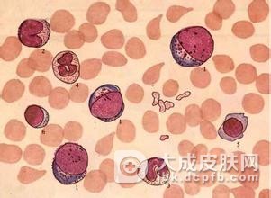 骨髓纤维化症状有哪些