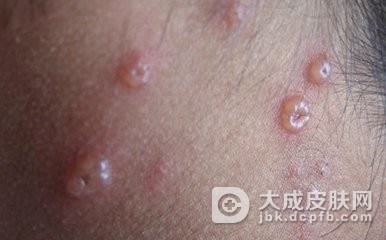秋冬进行性播散型水痘发生要注意什么？