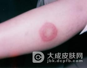 多形红斑为什么还被称猫眼疮