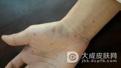 多形红斑的诱发因素都有哪些
