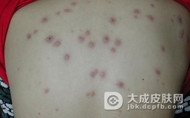 进行性播散型水痘会传染多久？