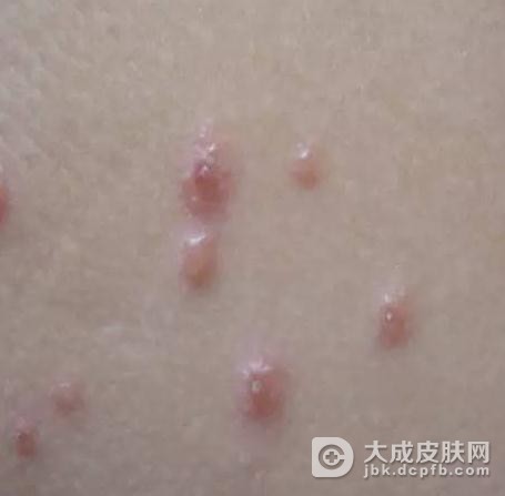 出进行性播散型水痘会导致带状疱疹吗