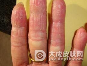 剥脱性角质松解症常见的症状有什么