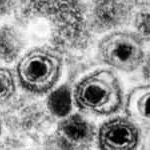 单纯疱疹病毒感染症的临床表现