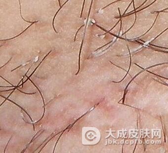 腋毛癣菌病的治疗方法