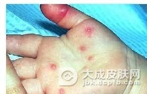 宝宝得了小儿紫斑湿疹综合征怎么办
