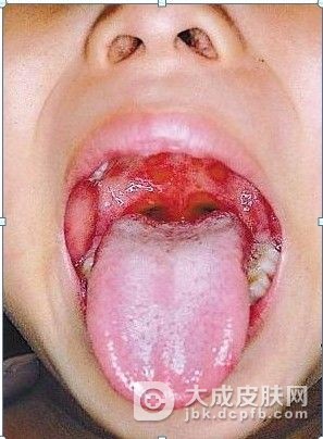 肠道病毒71型手足口病早期症状