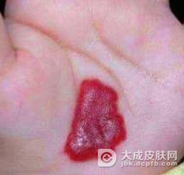 如何预防蔓状血管瘤蔓状血管瘤