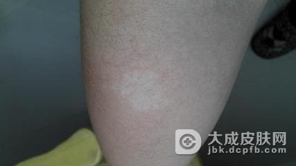 花斑癣是不是体癣