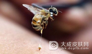 蜂螫伤的基本常识是什么