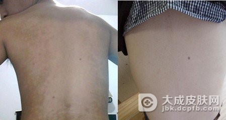 花斑癣的概述