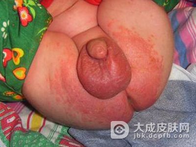 宝宝得了尿布皮炎怎么办？