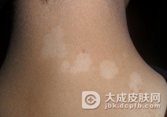 和疥疮类似的皮肤病有哪些