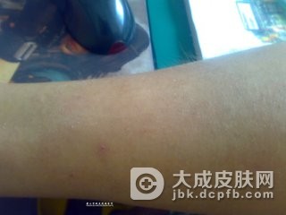 皮肤敏感的人很容易得银屑病吗