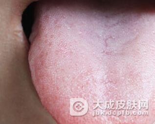 舌扁平苔藓是一种什么病