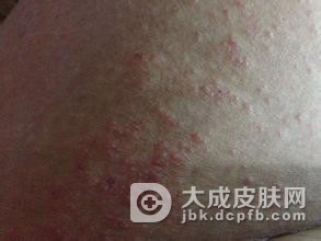 出现妊娠痒疹的时候有什么症状