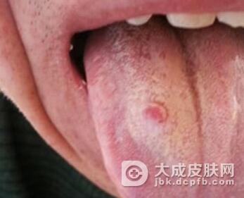 舌扁平苔藓的发病原因有哪些