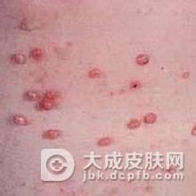 寻常疣的症状表现有哪些呢