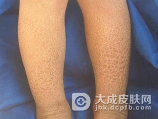 皮肤病的皮炎症状有哪些特点