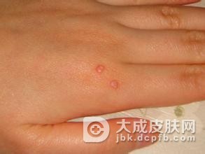 寻常疣的预防方法有哪些