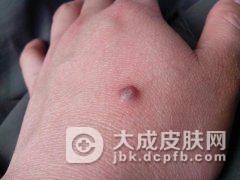 为什么会出现寻常疣呢