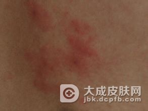 夏季怎样预防皮肤病病荨麻疹的发生？