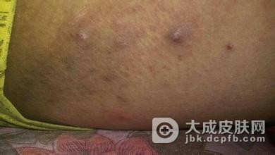 结节性痒疹是传染性疾病吗