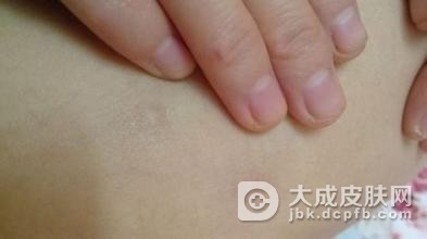 结节性痒疹的诱发条件是什么
