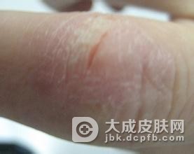 民间治疗冻疮的小偏方都有什么呢