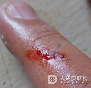 电灼伤后如何处理