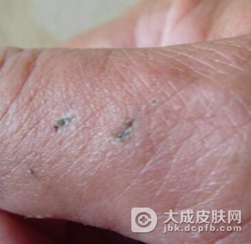 电灼伤的皮肤怎么护理
