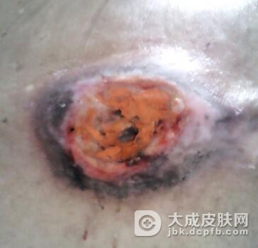 怎么判断是否患了褥疮