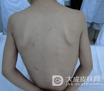 营养不良性皮肤钙化病的症状有哪些