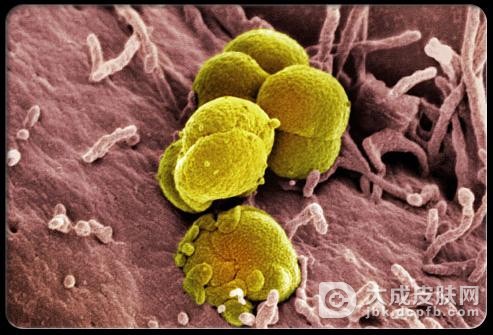 播散性淋球菌5种感染