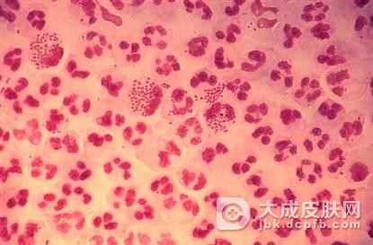 淋球菌感染会引发什么疾病