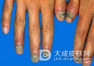 甲内型甲真菌病如何预防