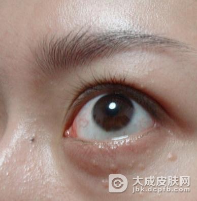 专家教你如何区别鱼鳞病与汗管瘤？