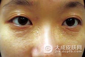 眼睛周围长汗管瘤有什么影响吗