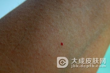 鲜红斑痣是怎么回事