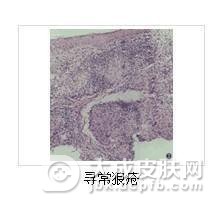 引发寻常狼疮的病因是什么