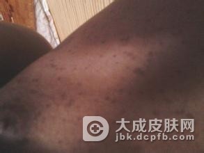 神经纤维瘤病是由什么引起的