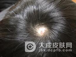 医生对斑秃症状的介绍