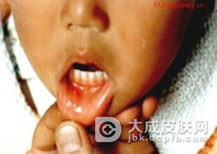 足口病与口蹄疫怎么辨别