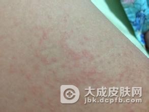 妊娠痒疹是一种怎样的疾病