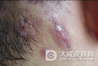 什么是脱发性毛囊炎