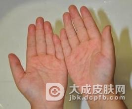 手湿疹病因是什么