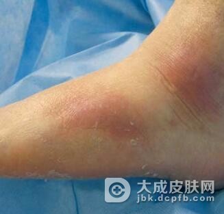 患了急性蜂窝组织炎怎样治疗