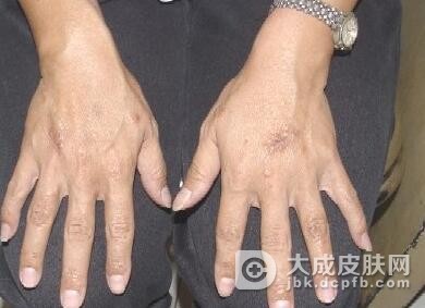 风搔痒饮食要注意什么